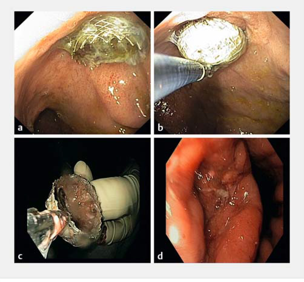 Endoscopic removal of lumen-apposing-5.jpg