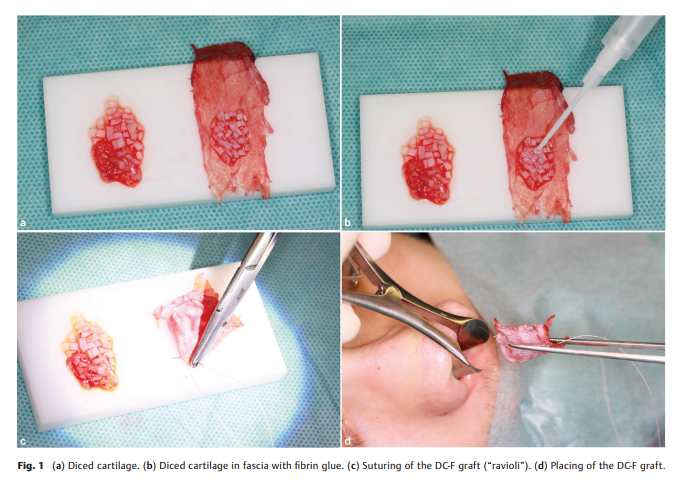 Closure of Nasal Septa.png