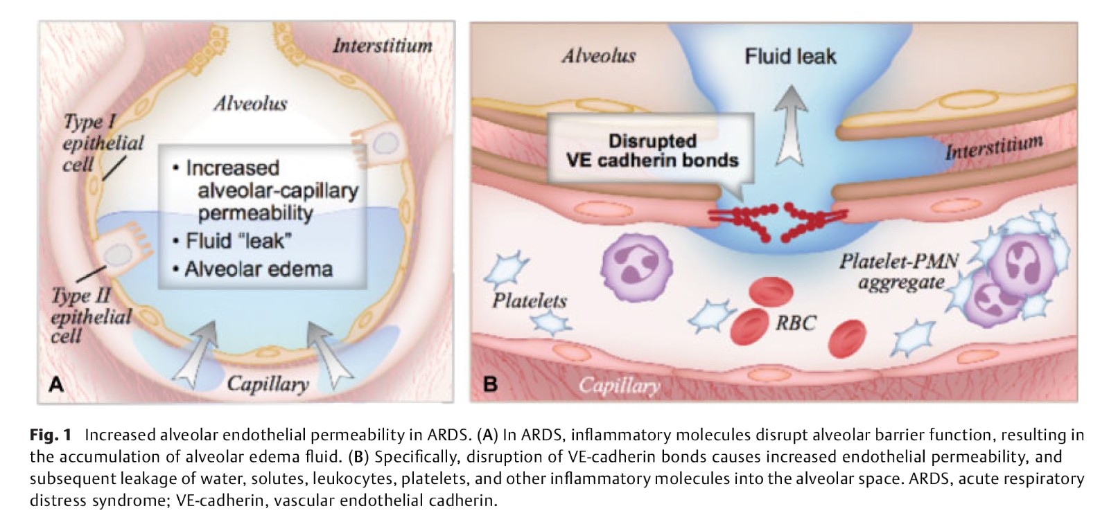 Pathogenesis of Acute Respiratory-2.jpg