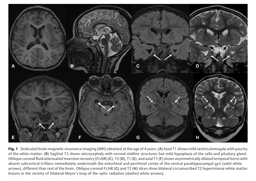 Intracranial MRI Findings.jpg
