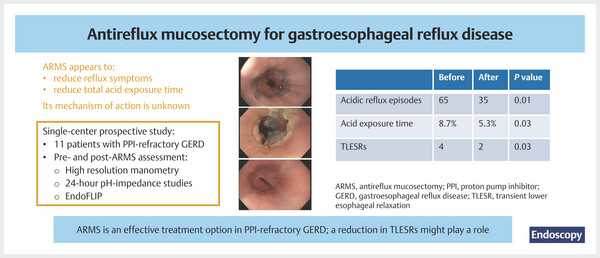 Antireflux mucosectomy for gastroesophageal.jpg