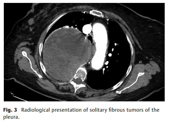 Solitary Fibrous Tumor2.png