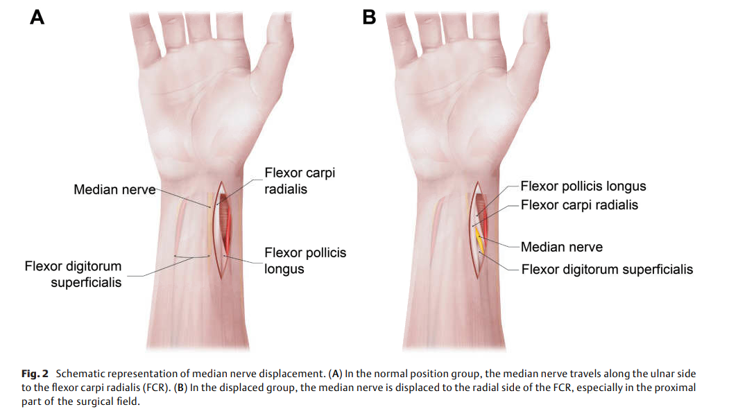 691ae4a7679f8.png Median Nerve Displacement.png