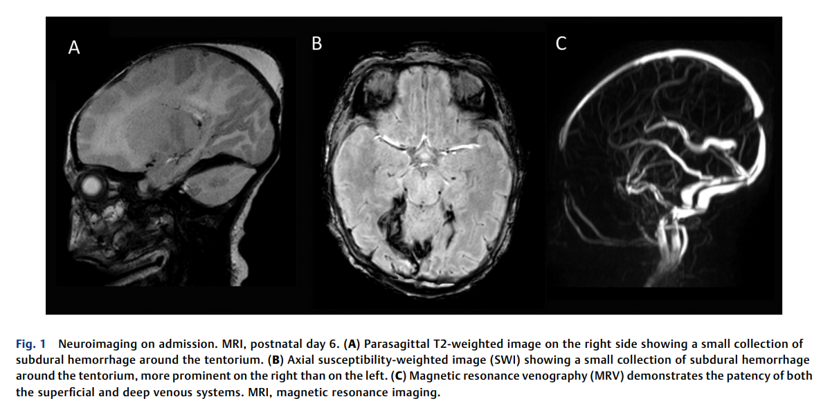 Perinatal Stroke 2.png