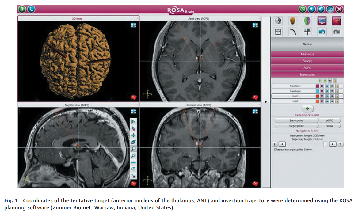 Half Burr-Hole 2.png