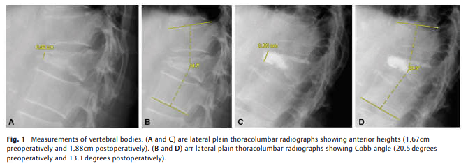 Effect of Kyphoplasty-2.png