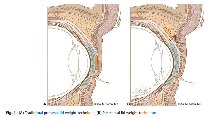 69dc5ae312d04.png Upper Eyelid Postseptal 2.png