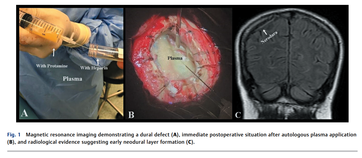 Duraplasty with Autologous Blood 2.png