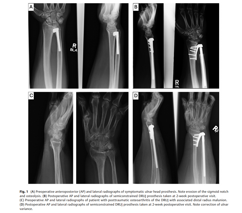 Semiconstrained Distal.png