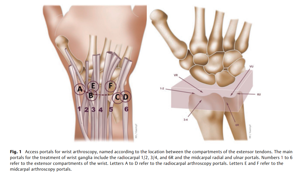 Arthroscopic Resection.png