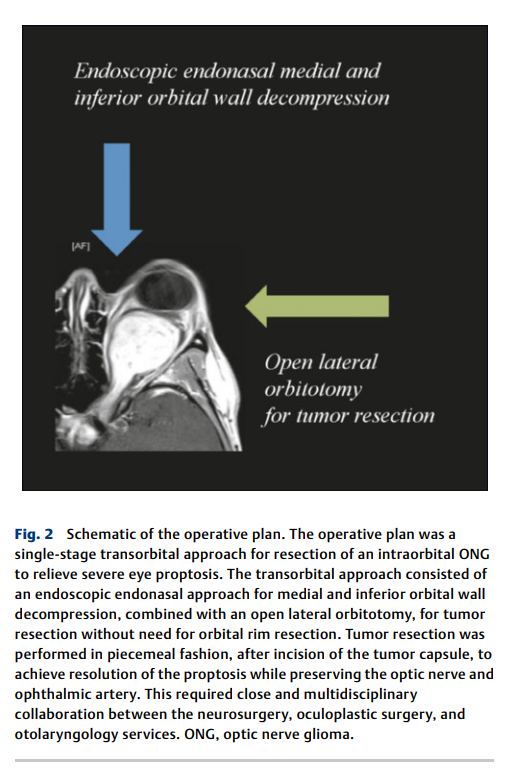 Transorbital Resection of an Optic Nerve 2.png