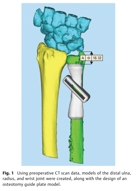 6a5dc4f035f56.png Ulnar Shortening Osteotomy 2.png